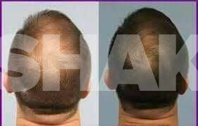 100% EFFECTIVE PAMPAKAL MAPAHABA NG BUHOK !!